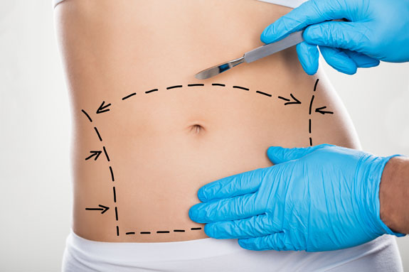 Abdominoplastik Duisburg